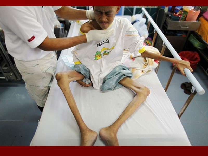 Стадии болезни СПИДа Заражение инфекцией ВИЧ: недельная лихорадка, увеличение лимфатических узлов, сыпь. Через месяц